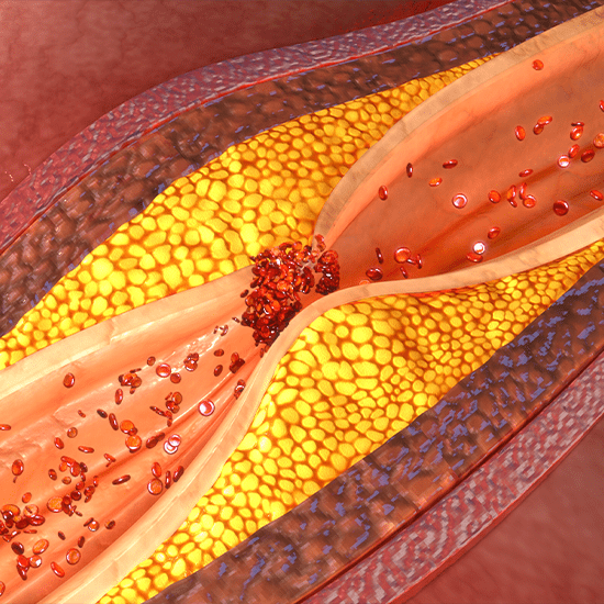 coronary artery plaque 