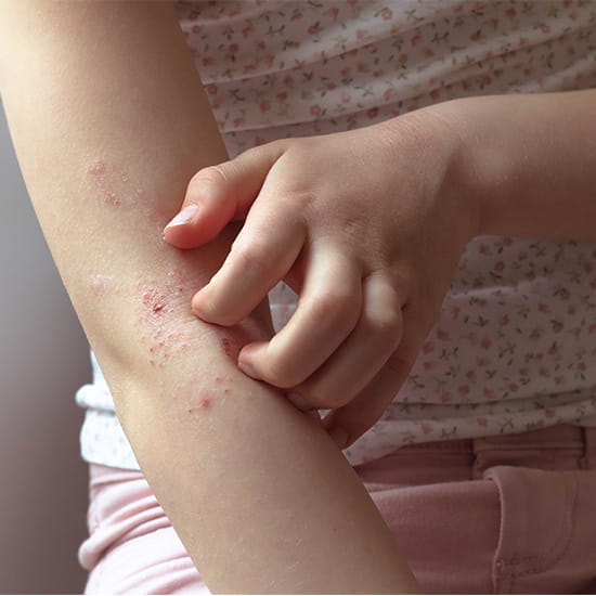 A child scratching an eczema