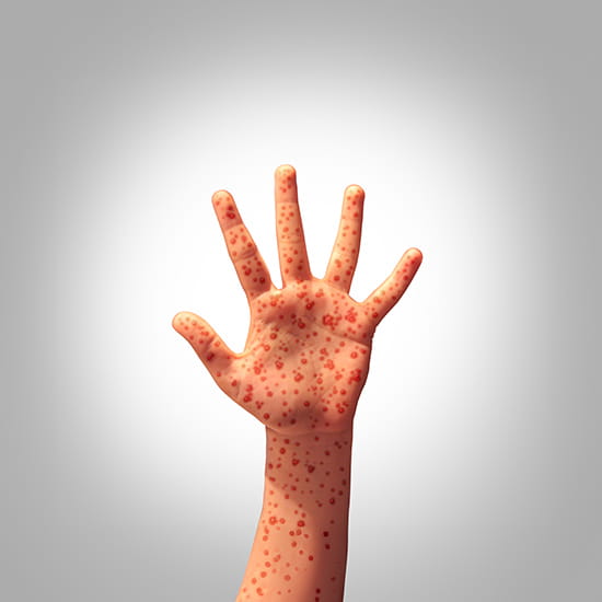 measles hand