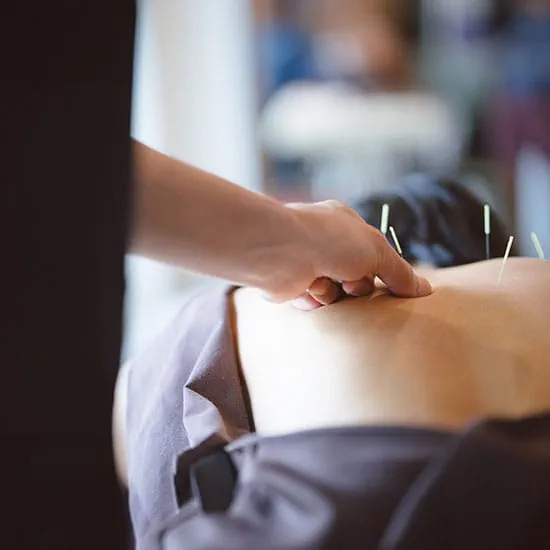 Patient receiving acupuncture treatment