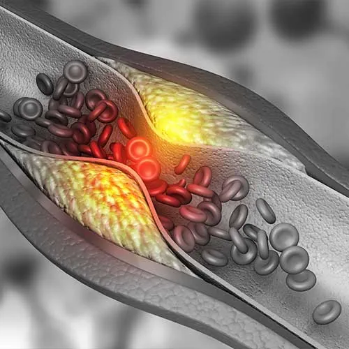 Artery blocked with bad cholesterol. clogged arteries, coronary artery plaque.