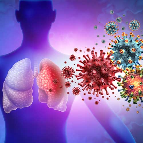 Triple Virus Lung Infection and Tripledemic Human lung infection and respiratory inflammation disease as influenza flu outbreak or pneumonia and pulmonary inflammatory illness with 3D illustration elements.