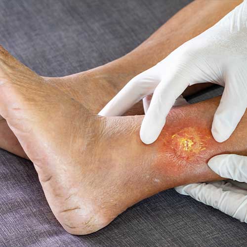 Doctor wearing a white hygienic glove and holding an elderly woman's leg to check for gangrene due to diabetes.