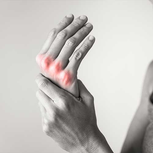 Arthritis inflammation.
