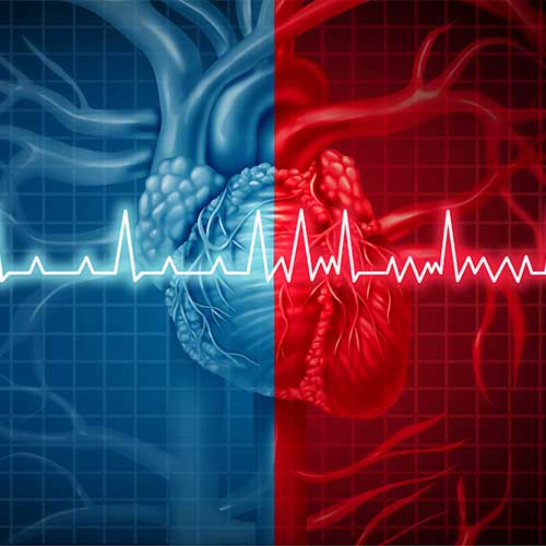 Atrial Fibrillation