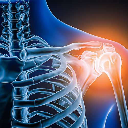 Anterior or front view of human shoulder joint and bones with inflammation 3D rendering illustration. Pathology, articular pain, anatomy, osteology, rheumatism, medical and healthcare concept