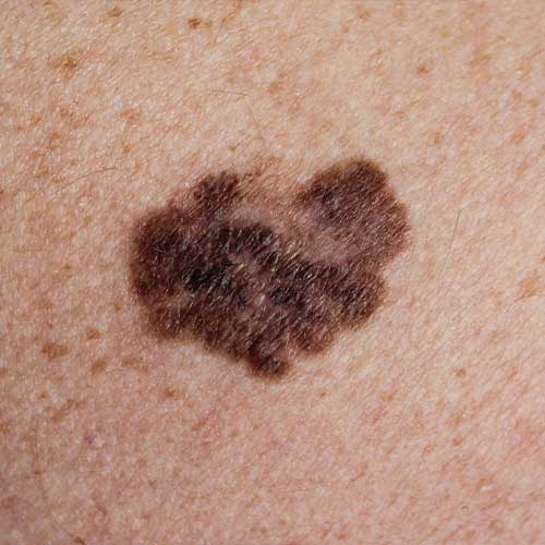 Photos of melanoma without magnification and with a tenfold magnification using a dermatoscope
