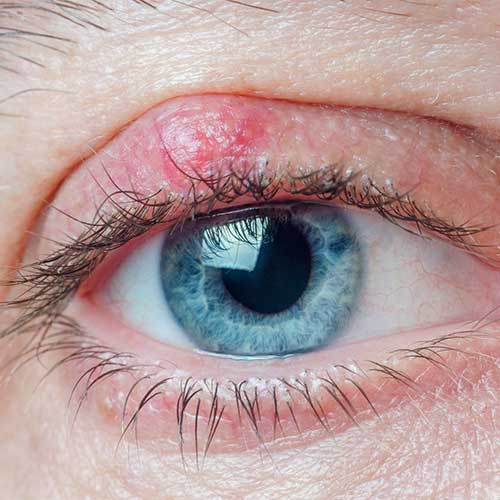 Chalazion on the eyelid of a man close-up.