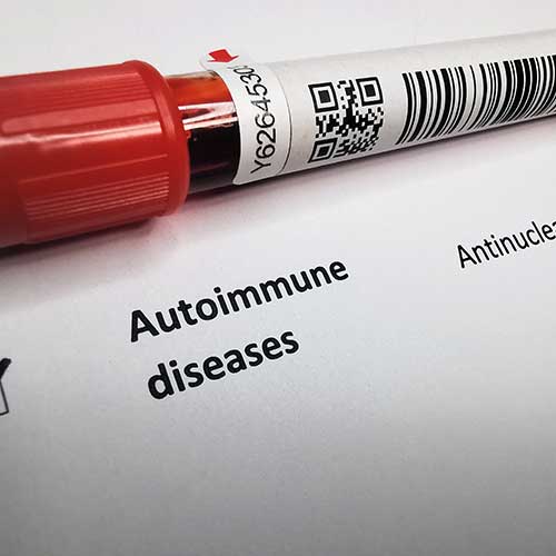 The image shows a medical test vial labeled for antinuclear antibody (ANA) testing, a key diagnostic tool for autoimmune diseases. ANA tests detect antibodies that the immune system produces against its own tissues, signaling the presence of an autoimmune disorder such as lupus, rheumatoid arthritis, or scleroderma. The vial has a red cap and includes a QR code on the label for efficient patient data management and tracking within clinical settings. This test is crucial for diagnosing autoimmune diseases and monitoring the immune response in patients.