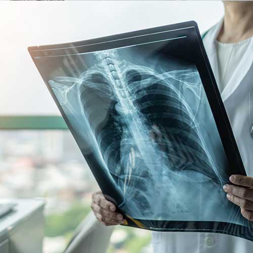 Doctor diagnosing patients health on asthma, lung disease, COVID-19 or bone cancer illness with radiological chest x-ray film for medical healthcare hospital service