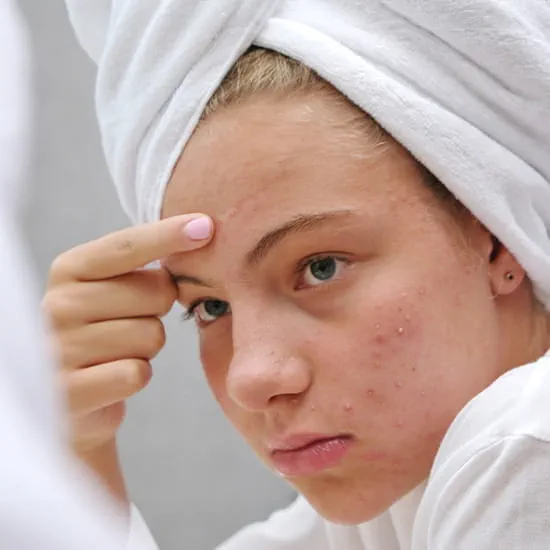 teen girl with acne