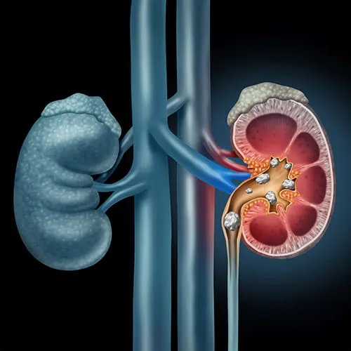 Medical illustration of a kidney stone