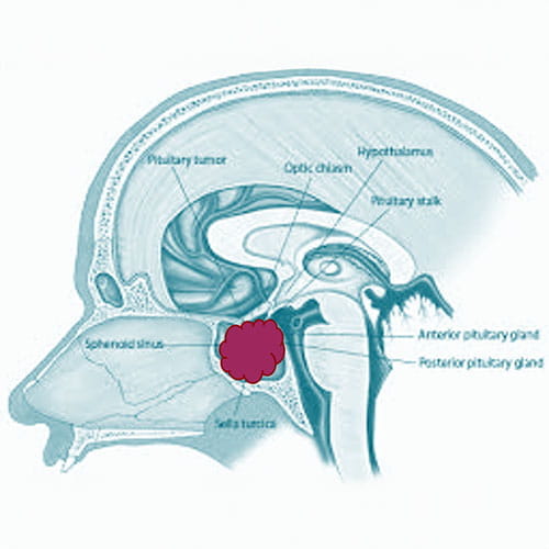 Medical illustration of acromegaly