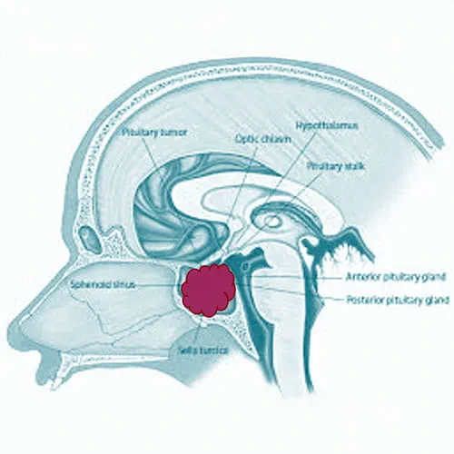 Medical illustration of acromegaly