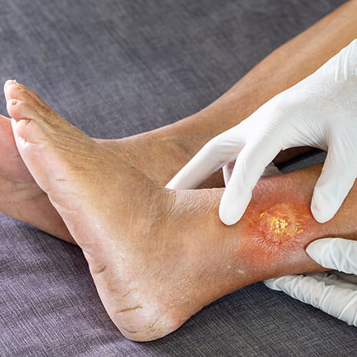 Doctor treating a foot wound