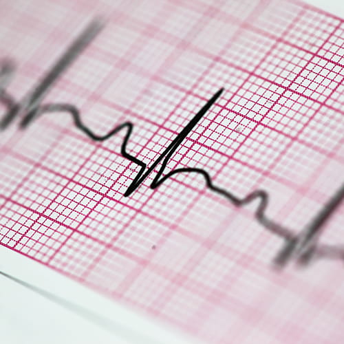 Close-up of an electrocardiogram (ECG) printout on pink grid paper, showing a single heartbeat waveform.