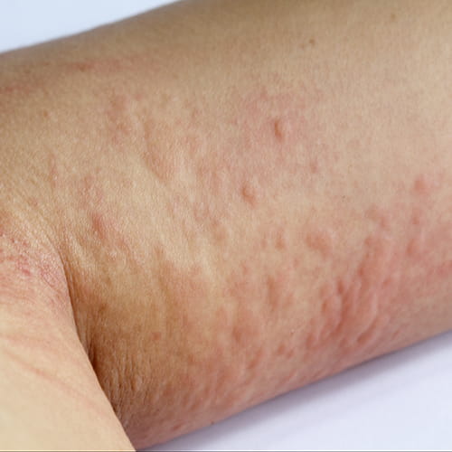 An arm with a rash.