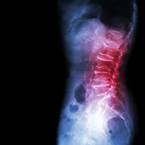 X-ray of a spine.