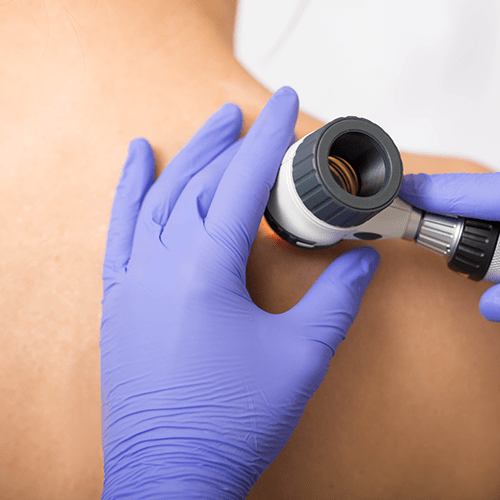Doctor examining a patient's skin moles with a dermoscope.