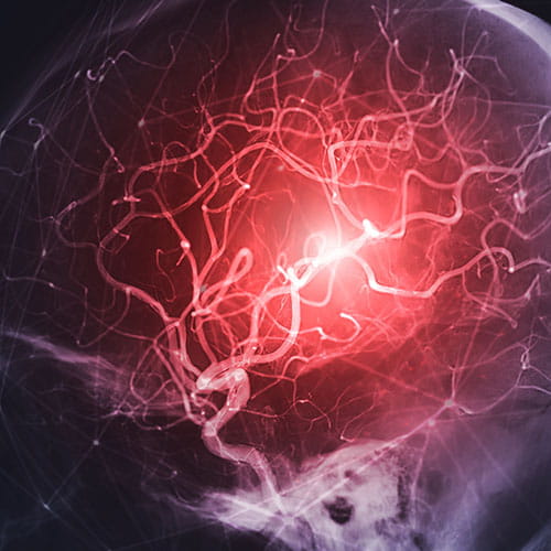 Cerebral angiography image from Fluoroscopy in intervention radiology showing cerebral artery