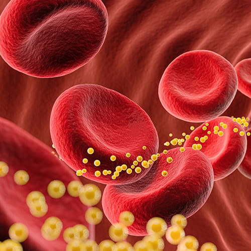 dyslipidemia cholesterol