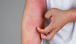 person itching a rash